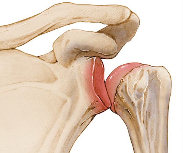Shoulder dislocation and luxation